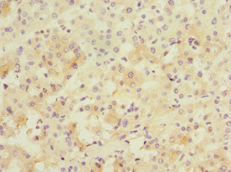 Immunohistochemistry of paraffin-embedded human liver cancer using PPM1D Antibody at dilution of 1:100Rabbit anti-Human PPM1D Polyclonal Antibody