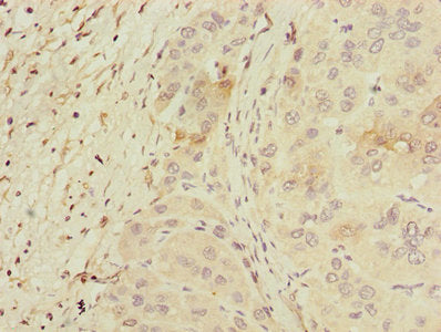 Immunohistochemistry of paraffin-embedded human liver cancer using PPM1D Antibody at dilution of 1:100Rabbit anti-Human PPM1D Polyclonal Antibody