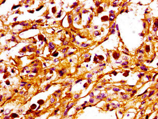 IHC image of PPM1F Antibody diluted at 1:100 and staining in paraffin-embedded human melanoma performed on a Leica BondTM system. After dewaxing and hydration, antigen retrieval was mediated by high pressure in a citrate buffer (pH 6.0). Section was blocked with 10% normal goat serum 30min at RT. Then primary antibody (1% BSA) was incubated at 4°C overnight. The primary is detected by a biotinylated secondary antibody and visualized using an HRP conjugated SP system.Rabbit anti-Human PPM1F Polyclonal Antibody