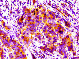 IHC image of PPM1F Antibody diluted at 1:100 and staining in paraffin-embedded human pancreatic cancer performed on a Leica BondTM system. After dewaxing and hydration, antigen retrieval was mediated by high pressure in a citrate buffer (pH 6.0). Section was blocked with 10% normal goat serum 30min at RT. Then primary antibody (1% BSA) was incubated at 4°C overnight. The primary is detected by a biotinylated secondary antibody and visualized using an HRP conjugated SP system.Rabbit anti-Human PPM1F Polyclonal Antibody