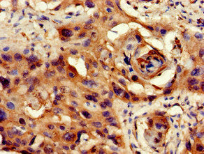 Immunohistochemistry of paraffin-embedded human cervical cancer using PPP1CB Antibody at dilution of 1:100Rabbit anti-Human PPP1CB Polyclonal Antibody