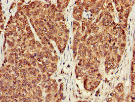 Immunohistochemistry of paraffin-embedded human ovarian cancer using PPP1CB Antibody at dilution of 1:100Rabbit anti-Human PPP1CB Polyclonal Antibody