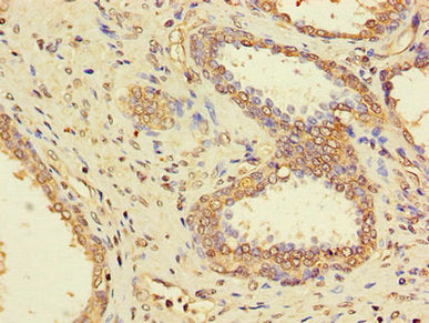 Immunohistochemistry of paraffin-embedded human prostate cancer using PPP1CC Antibody at dilution of 1:100Rabbit anti-Human PPP1CC Polyclonal Antibody