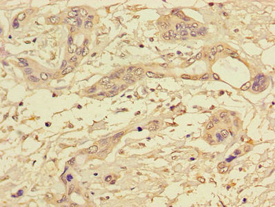 Immunohistochemistry of paraffin-embedded human pancreatic cancer using PPP1CC Antibody at dilution of 1:100Rabbit anti-Human PPP1CC Polyclonal Antibody