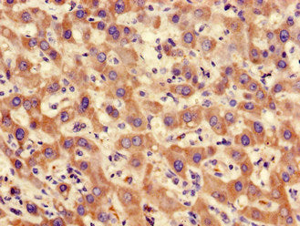 Immunohistochemistry of paraffin-embedded human liver cancer using PPP2CA Antibody at dilution of 1:100Rabbit anti-Human PPP2CA Polyclonal Antibody