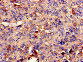 Immunohistochemistry of paraffin-embedded human melanoma using PPP2R2A Antibody at dilution of 1:100Rabbit anti-Human PPP2R2A Polyclonal Antibody