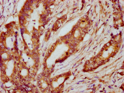 IHC image of PPP2R2B Antibody diluted at 1:600 and staining in paraffin-embedded human colon cancer performed on a Leica BondTM system. After dewaxing and hydration, antigen retrieval was mediated by high pressure in a citrate buffer (pH 6.0). Section was blocked with 10% normal goat serum 30min at RT. Then primary antibody (1% BSA) was incubated at 4°C overnight. The primary is detected by a biotinylated secondary antibody and visualized using an HRP conjugated SP system.Rabbit anti-Human PPP2R2B Polyclonal Antibody