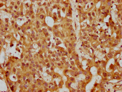 IHC image of PPP5C Antibody diluted at 1:200 and staining in paraffin-embedded human liver cancer performed on a Leica BondTM system. After dewaxing and hydration, antigen retrieval was mediated by high pressure in a citrate buffer (pH 6.0). Section was blocked with 10% normal goat serum 30min at RT. Then primary antibody (1% BSA) was incubated at 4°C overnight. The primary is detected by a biotinylated secondary antibody and visualized using an HRP conjugated SP system.Rabbit anti-Human PPP5C Polyclonal Antibody