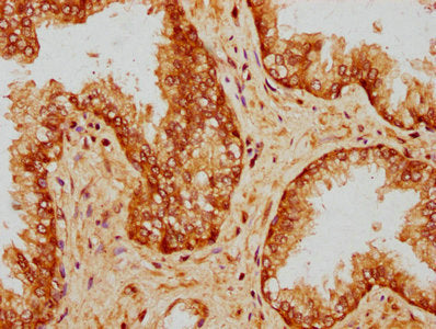 IHC image of PPP5C Antibody diluted at 1:200 and staining in paraffin-embedded human prostate cancer performed on a Leica BondTM system. After dewaxing and hydration, antigen retrieval was mediated by high pressure in a citrate buffer (pH 6.0). Section was blocked with 10% normal goat serum 30min at RT. Then primary antibody (1% BSA) was incubated at 4°C overnight. The primary is detected by a biotinylated secondary antibody and visualized using an HRP conjugated SP system.Rabbit anti-Human PPP5C Polyclonal Antibody