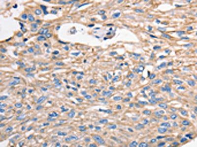 The image on the left is immunohistochemistry of paraffin-embedded Human esophagus cancer tissue using MVP Antibody(MVP Antibody) at dilution 1/40, on the right is treated with fusion protein. (Original magnification: ×200)Rabbit anti-Human MVP Polyclonal Antibody