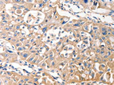 The image on the left is immunohistochemistry of paraffin-embedded Human lung cancer tissue using the antibody Antibody) at dilution 1/40, on the right is treated with fusion protein. (Original magnification: ×200)Rabbit anti-Human MVP Polyclonal Antibody