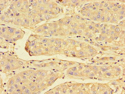 Immunohistochemistry of paraffin-embedded human liver cancer using PRDX3 Antibody at dilution of 1:100Rabbit anti-Human PRDX3 Polyclonal Antibody