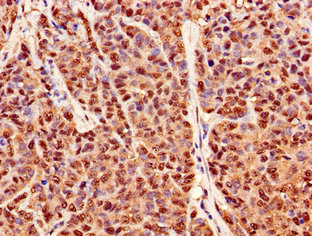 Immunohistochemistry of paraffin-embedded human ovarian cancer using PRDX6 Antibody at dilution of 1:100Rabbit anti-Human PRDX6 Polyclonal Antibody