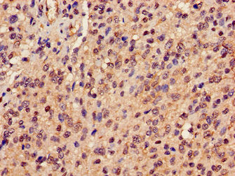 Immunohistochemistry of paraffin-embedded human glioma using PRDX6 Antibody at dilution of 1:100Rabbit anti-Human PRDX6 Polyclonal Antibody