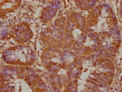 IHC image of PREP Antibody diluted at 1:100 and staining in paraffin-embedded human colon cancer performed on a Leica BondTM system. After dewaxing and hydration, antigen retrieval was mediated by high pressure in a citrate buffer (pH 6.0). Section was blocked with 10% normal goat serum 30min at RT. Then primary antibody (1% BSA) was incubated at 4°C overnight. The primary is detected by a biotinylated secondary antibody and visualized using an HRP conjugated SP system.Rabbit anti-Human PREP Polyclonal Antibody