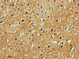 Immunohistochemistry of paraffin-embedded human glioma using PRKAR2A Antibody at dilution of 1:100Rabbit anti-Human PRKAR2A Polyclonal Antibody