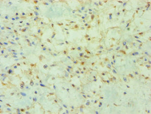 Immunohistochemistry of paraffin-embedded human breast cancer using PRMT2 Antibody at dilution of 1:100