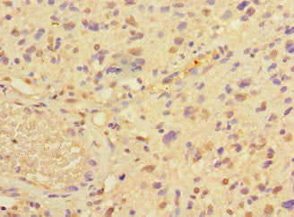 Immunohistochemistry of paraffin-embedded human glioma using PRMT3 Antibody at dilution of 1:100Rabbit anti-Human PRMT3 Polyclonal Antibody