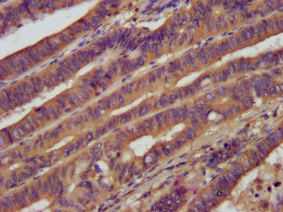 IHC image of PROM1 Antibody diluted at 1:1200 and staining in paraffin-embedded human colon cancer performed on a Leica BondTM system. After dewaxing and hydration, antigen retrieval was mediated by high pressure in a citrate buffer (pH 6.0). Section was blocked with 10% normal goat serum 30min at RT. Then primary antibody (1% BSA) was incubated at 4°C overnight. The primary is detected by a biotinylated secondary antibody and visualized using an HRP conjugated SP system.Rabbit anti-Human PROM1 Polyclonal Antibody