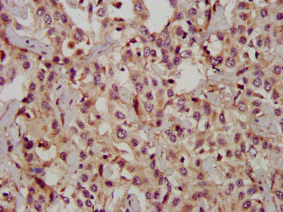 IHC image of PROM1 Antibody diluted at 1:1200 and staining in paraffin-embedded human liver cancer performed on a Leica BondTM system. After dewaxing and hydration, antigen retrieval was mediated by high pressure in a citrate buffer (pH 6.0). Section was blocked with 10% normal goat serum 30min at RT. Then primary antibody (1% BSA) was incubated at 4°C overnight. The primary is detected by a biotinylated secondary antibody and visualized using an HRP conjugated SP system.Rabbit anti-Human PROM1 Polyclonal Antibody