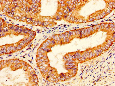 IHC image of the antibody diluted at 1:200 and staining in paraffin-embedded human endometrial cancer performed on a Leica BondTM system. After dewaxing and hydration, antigen retrieval was mediated by high pressure in a citrate buffer (pH 6.0). Section was blocked with 10% normal goat serum 30min at RT. Then primary antibody (1% BSA) was incubated at 4°C overnight. The primary is detected by a biotinylated secondary antibody and visualized using an HRP conjugated SP system.Rabbit anti-Human PROS1 Polyclonal Antibody