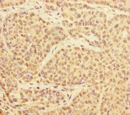 Immunohistochemistry of paraffin-embedded human ovarian cancer using PRPF4 Antibody at dilution of 1:100Rabbit anti-Human PRPF4 Polyclonal Antibody