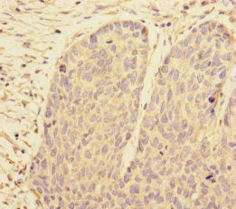 Immunohistochemistry of paraffin-embedded human ovarian cancer using PRPF4 Antibody at dilution of 1:100Rabbit anti-Human PRPF4 Polyclonal Antibody