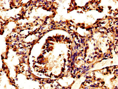 IHC image of PSAP Antibody diluted at 1:500 and staining in paraffin-embedded human lung tissue performed on a Leica BondTM system. After dewaxing and hydration, antigen retrieval was mediated by high pressure in a citrate buffer (pH 6.0). Section was blocked with 10% normal goat serum 30min at RT. Then primary antibody (1% BSA) was incubated at 4°C overnight. The primary is detected by a biotinylated secondary antibody and visualized using an HRP conjugated SP system.Rabbit anti-Human PSAP Polyclonal Antibody