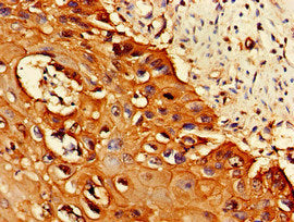 Immunohistochemistry of paraffin-embedded human cervical cancer using PSMA1 Antibody at dilution of 1:100Rabbit anti-Human PSMA1 Polyclonal Antibody
