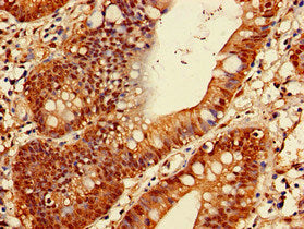 Immunohistochemistry of paraffin-embedded human colon cancer using PSMA1 Antibody at dilution of 1:100Rabbit anti-Human PSMA1 Polyclonal Antibody