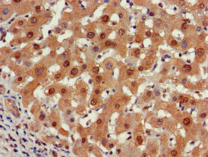 Immunohistochemistry of paraffin-embedded human liver cancer using PSMA5 Antibody at dilution of 1:100Rabbit anti-Human PSMA5 Polyclonal Antibody