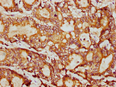 IHC image of PSMB9 Antibody diluted at 1:400 and staining in paraffin-embedded human colon cancer performed on a Leica BondTM system. After dewaxing and hydration, antigen retrieval was mediated by high pressure in a citrate buffer (pH 6.0). Section was blocked with 10% normal goat serum 30min at RT. Then primary antibody (1% BSA) was incubated at 4°C overnight. The primary is detected by a biotinylated secondary antibody and visualized using an HRP conjugated SP system.Rabbit anti-Human PSMB9 Polyclonal Antibody