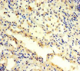Immunohistochemistry of paraffin-embedded human lung cancer using the antibody at dilution of 1:100Rabbit anti-Human PSMC3 Polyclonal Antibody