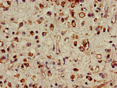 IHC image of PSMC4 Antibody diluted at 1:500 and staining in paraffin-embedded human glioma performed on a Leica BondTM system. After dewaxing and hydration, antigen retrieval was mediated by high pressure in a citrate buffer (pH 6.0). Section was blocked with 10% normal goat serum 30min at RT. Then primary antibody (1% BSA) was incubated at 4°C overnight. The primary is detected by a biotinylated secondary antibody and visualized using an HRP conjugated SP system.Rabbit anti-Human PSMC4 Polyclonal Antibody