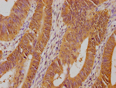 IHC image of PSMD14 Antibody diluted at 1:100 and staining in paraffin-embedded human colon cancer performed on a Leica BondTM system. After dewaxing and hydration, antigen retrieval was mediated by high pressure in a citrate buffer (pH 6.0). Section was blocked with 10% normal goat serum 30min at RT. Then primary antibody (1% BSA) was incubated at 4°C overnight. The primary is detected by a biotinylated secondary antibody and visualized using an HRP conjugated SP system.Rabbit anti-Human PSMD14 Polyclonal Antibody
