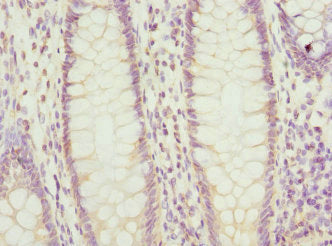 Immunohistochemistry of paraffin-embedded human colon cancer using PTGES2 Antibody at dilution of 1:100Rabbit anti-Human PTGES2 Polyclonal Antibody