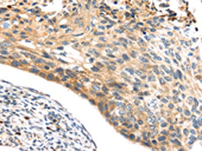 The image on the left is immunohistochemistry of paraffin-embedded Human esophagus cancer tissue using NOX3 Antibody(NOX3 Antibody) at dilution 1/30, on the right is treated with synthetic peptide. (Original magnification: ×200)Rabbit anti-Human NOX3 Polyclonal Antibody