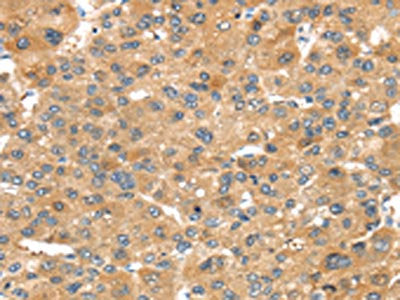 The image on the left is immunohistochemistry of paraffin-embedded Human liver cancer tissue using the antibody Antibody) at dilution 1/30, on the right is treated with synthetic peptide. (Original magnification: ×200)Rabbit anti-Human NOX3 Polyclonal Antibody