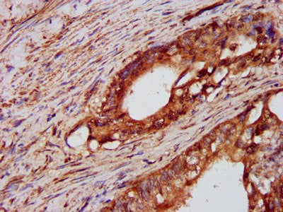IHC image of the antibody diluted at 1:600 and staining in paraffin-embedded human colon cancer performed on a Leica BondTM system. After dewaxing and hydration, antigen retrieval was mediated by high pressure in a citrate buffer (pH 6.0). Section was blocked with 10% normal goat serum 30min at RT. Then primary antibody (1% BSA) was incubated at 4°C overnight. The primary is detected by a biotinylated secondary antibody and visualized using an HRP conjugated SP system.Rabbit anti-Human PTPN3 Polyclonal Antibody