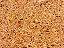 Immunohistochemistry of paraffin-embedded human glioma using PTPRZ1 Antibody at dilution of 1:100Rabbit anti-Human PTPRZ1 Polyclonal Antibody