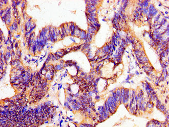 Immunohistochemistry of paraffin-embedded human colon cancer using PTX3 Antibody at dilution of 1:100Rabbit anti-Human PTX3 Polyclonal Antibody
