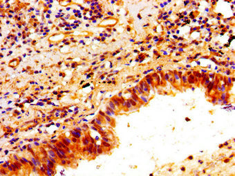 Immunohistochemistry of paraffin-embedded human lung cancer using PTX3 Antibody at dilution of 1:100Rabbit anti-Human PTX3 Polyclonal Antibody