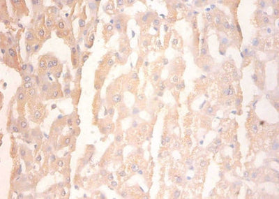 Immunohistochemistry of paraffin-embedded human liver tissue using PYGL Antibody at dilution of 1:100Rabbit anti-Human PYGL Polyclonal Antibody