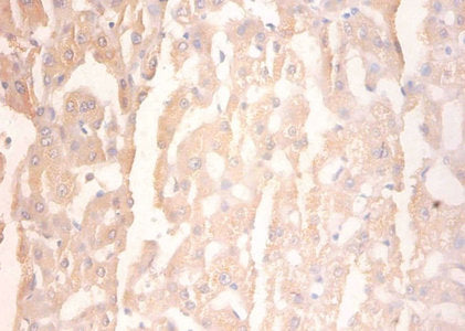 Immunohistochemistry of paraffin-embedded human liver tissue using PYGL Antibody at dilution of 1:100Rabbit anti-Human PYGL Polyclonal Antibody
