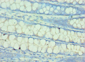 Immunohistochemistry of paraffin-embedded human colon tissue using QARS Antibody at dilution of 1:100Rabbit anti-Human QARS Polyclonal Antibody