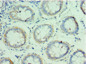 Immunohistochemistry of paraffin-embedded human colon cancer using QARS Antibody at dilution of 1:100Rabbit anti-Human QARS Polyclonal Antibody