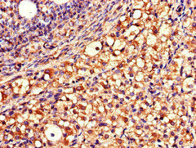 Immunohistochemistry of paraffin-embedded human ovarian cancer using QDPR Antibody at dilution of 1:100Rabbit anti-Human QDPR Polyclonal Antibody
