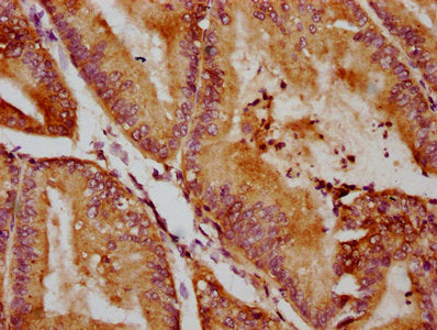 IHC image of QSOX1 Antibody diluted at 1:400 and staining in paraffin-embedded human endometrial cancer performed on a Leica BondTM system. After dewaxing and hydration, antigen retrieval was mediated by high pressure in a citrate buffer (pH 6.0). Section was blocked with 10% normal goat serum 30min at RT. Then primary antibody (1% BSA) was incubated at 4°C overnight. The primary is detected by a biotinylated secondary antibody and visualized using an HRP conjugated SP system.