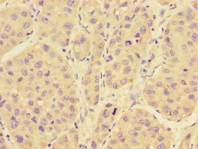 Immunohistochemistry of paraffin-embedded human liver cancer using RAB28 Antibody at dilution of 1:100Rabbit anti-Human RAB28 Polyclonal Antibody