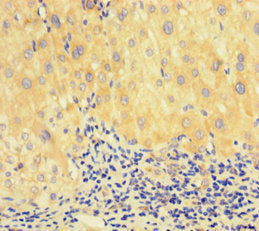 Immunohistochemistry of paraffin-embedded human liver cancer using RAD51 Antibody at dilution of 1:100Rabbit anti-Human RAD51 Polyclonal Antibody